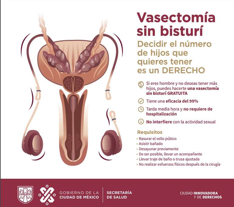 CDMX: Vasectomía sin Bisturí Gratuita